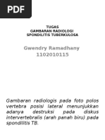 Gambaran Radiologi Spondilitis Tuberkulosa