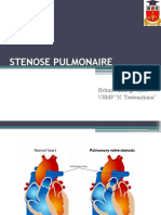 Stenose Pulmonaire