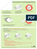 Procedure For Use of Vacuum Extractor-Poster