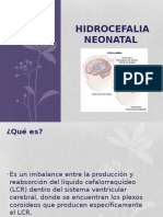 Hidrocefalia