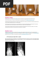 Hindfoot Valgus: AP Talocalcaneal Angle (Kite's Angle)