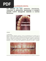 6 Causas de La Erosión Dental