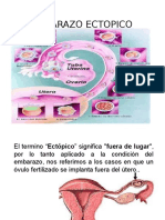 Embarazo - Ectopico Mapas Conceptuales