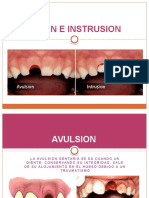 Avulsion e Instrusion