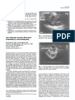 Left Ventricular Myxoma Discovered Incidentally by Echocardiography