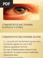 Conjuntivitis Bacteriana, Alérgica y Otras (ALE)