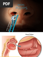 Nasal Polyps