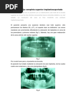 Prótesis Fija Completa Superior Implantosoportada