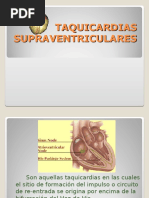 Taquicardias Supraventriculares