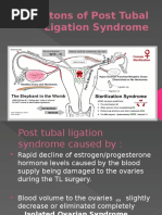 Post Tubal Ligation Syndrome