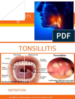 Tonsillitis