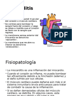 Miocarditis