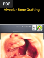 Alveolar Bone Grafting.