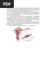 Ectopic Pregnancy - CS