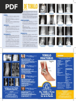 Tobillo Fracturas