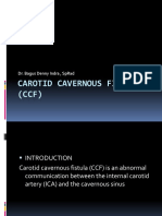 Carotid Cavernous Fisstula (CCF)