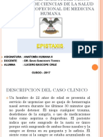 Caso Clinico Epistaxis Posterior