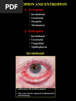 06ectropion & Entropion