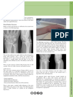 Wrist Fractures: Musculoskeletal Trauma