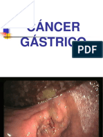 Cancer Gastrico