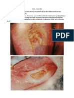 Differente Intre Ulceratiile Secundare Ale Arsuri, Cancer, Herpes, Sifilis, TBC