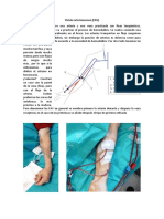 Fístula Arteriovenosa