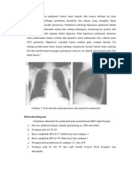 Cor Pulmonal