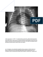 Cardiac Tamponade