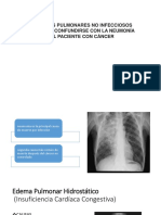 Infiltrados Pulmonares No Infecciosos Que Pueden Confundirse Con