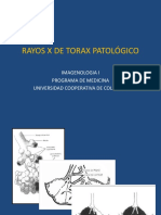 Alteraciones de La Transparencia Pulmonar PDF