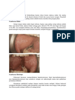 Keratosis Friksional