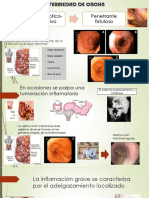 Enfermedad de Crohn