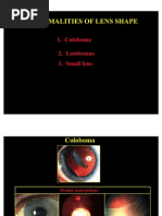 Abnormal Lens Shape