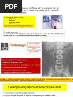 Tuberculosis Urogenital