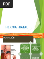 Presentacion Hernia Hiatal