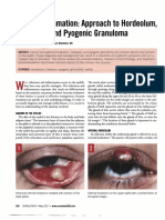 Hordeulum, Chalazion, Pyogenic Granuloma