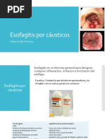 Esofagitis Por Cáusticos