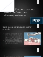 Preparación para Corona Metal Cerámica en Dientes Posteriores