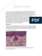 Carcinoma de Cuello Uterino