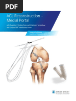 Acl Reconstruction Medial Portal With Toggleloc Fixation Device With Ziploop Technology and Compositcp Interference Screw Surgical Technique