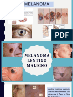 Melanoma Lentigo