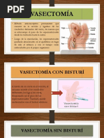 Vasectomía