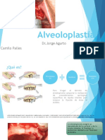 Alveoloplastía