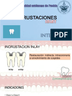 Incrustaciones Inlay