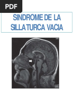 Sindrome de La Silla Turca Vacia