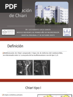 Malformacion de Chiari