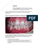 Tipos de Gingivitis