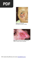 Figura 25. Carcinoma: Basocelular de Aspecto Nodular