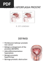 Benigna Hiperplasia Prostat