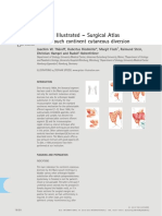 Surgery Illustrated - Surgical Atlas: Mainz Pouch Continent Cutaneous Diversion